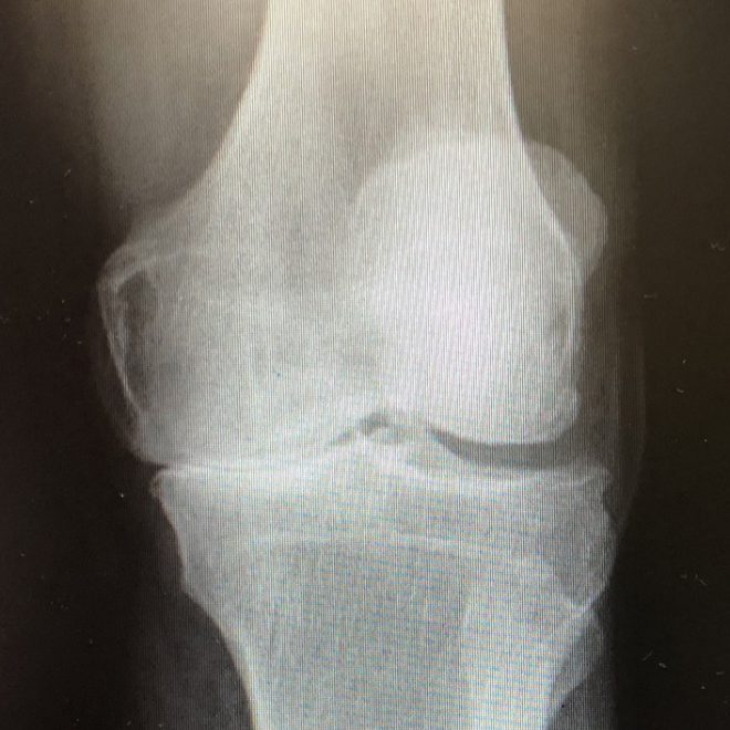 Artrosis de rodilla Doctor De Felipe gallego